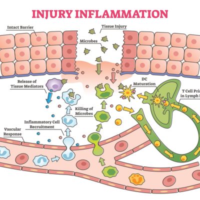 Injury,Inflammation,Process,As,Body,Response,To,Microbes,In,Wound Injury,Inflammation,Process,As,Body,Response,To,Microbes,In,Wound